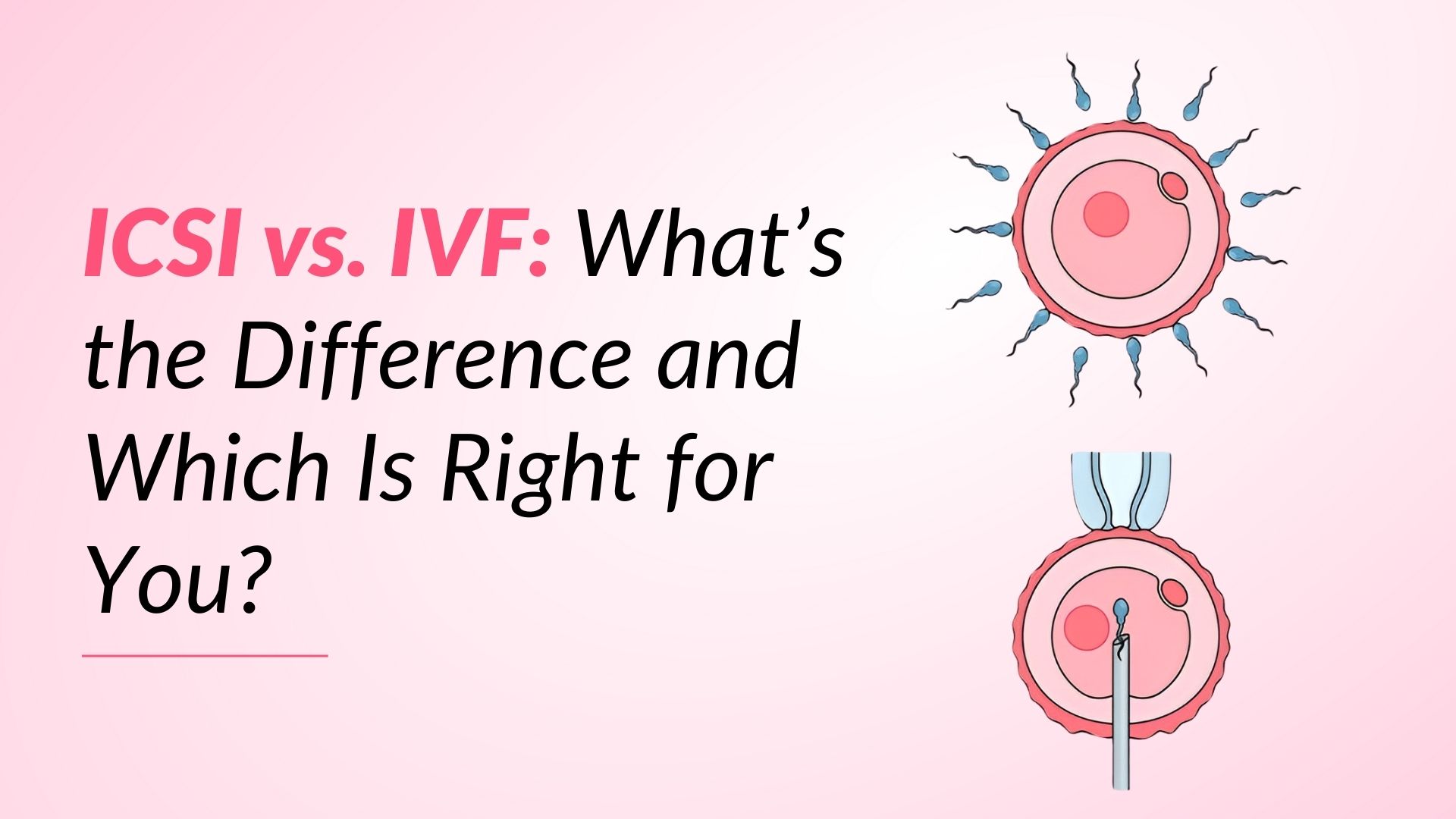 ICSI vs. IVF