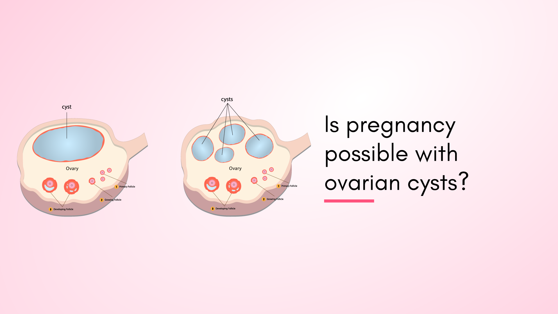 Is Pregnancy Possible with Ovarian Cysts