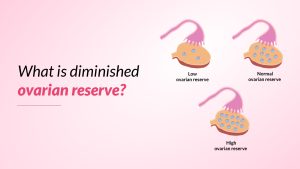 What is diminished ovarian reserve